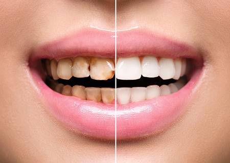 Preventive Dentistry - Ways to Improve Dental Health