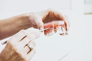 Dental Implants - Full Teeth Replacement