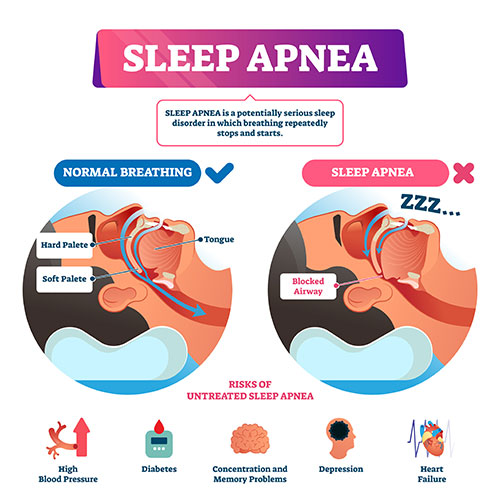 Sleep Apnea Syndrome