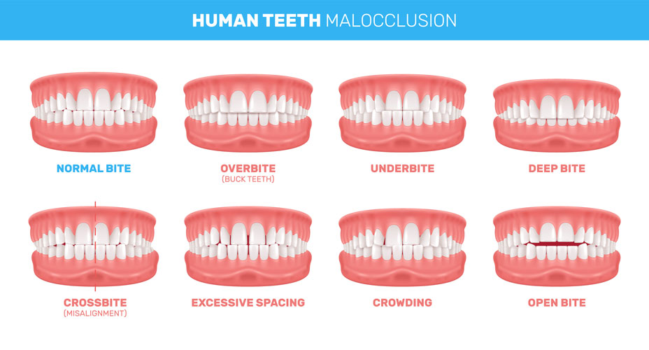 malocclusion infographic